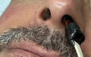 depilacion facial hombre